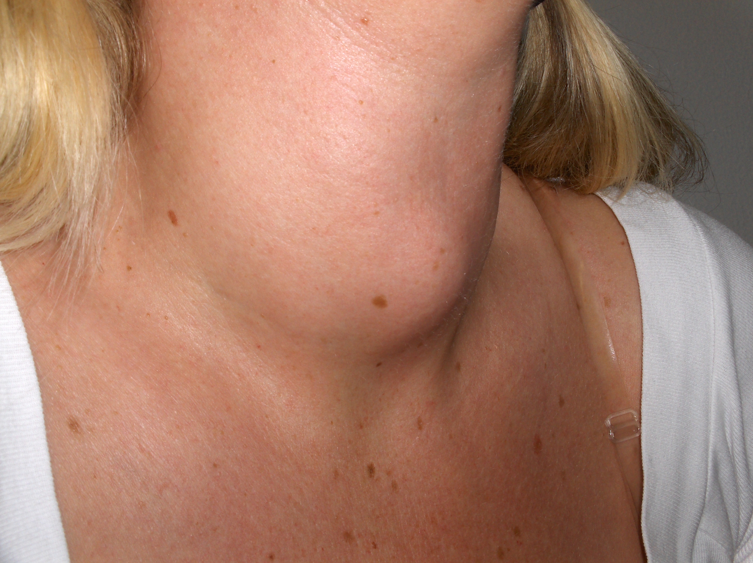﻿Hyperthyroidism more commonly affects women
